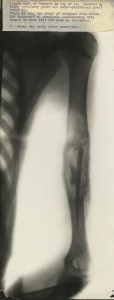 14 year old male with cyst of the humerus treated with with intra-medullary and osteo-periosteal grafts.  6 weeks after operations HOSP/STAN/10/1/30/3