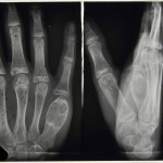 Tuberculosis affecting the finger bones: HOSP-STAN-07-01-02-641_07