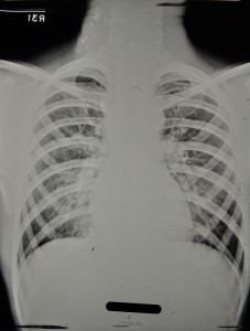 Figure 7 - HOSP/STAN/7/1/2/1371_14 Chest X-ray, 17 Feb 1950, also showing calcifications in neck glands.