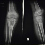 Tuberculosis of the Knee: HOSP-STAN-07-01-02-91_09